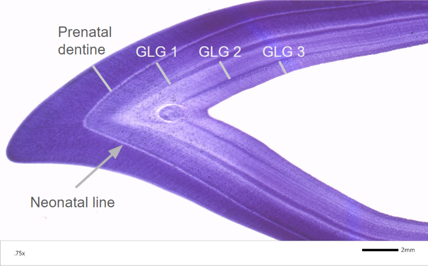 The tooth cross section is approximately 23 millimeters and shaped like a V. The outermost layer is darkest in color and ends at a light band labeled "neonatal line." From there, the layers are separated by thin dark bands. The first layer is labeled "prenatal dentine" followed by 3 GLG bands.
